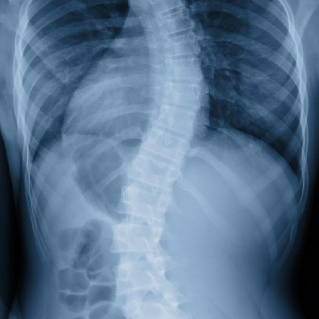 Cirurgia De Escoliose Dr Guilherme Foizer