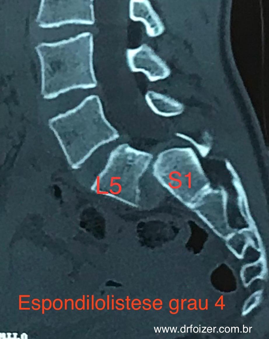 tomografia lombar com espondilolistese