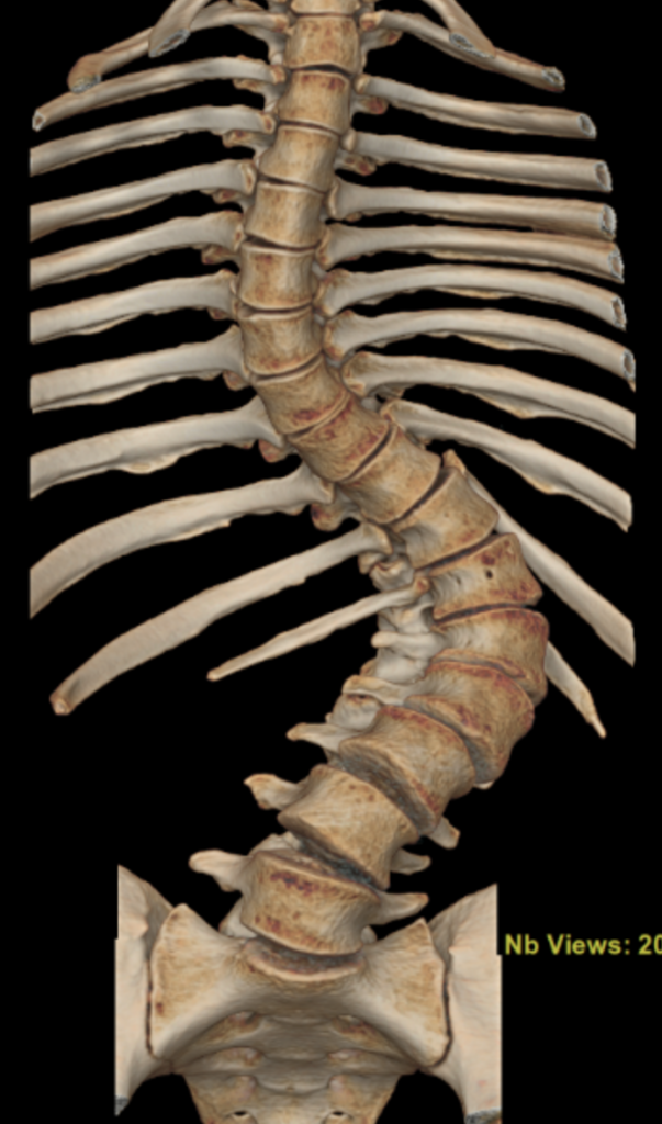 imagem de tomografia com coluna e grave escoliose