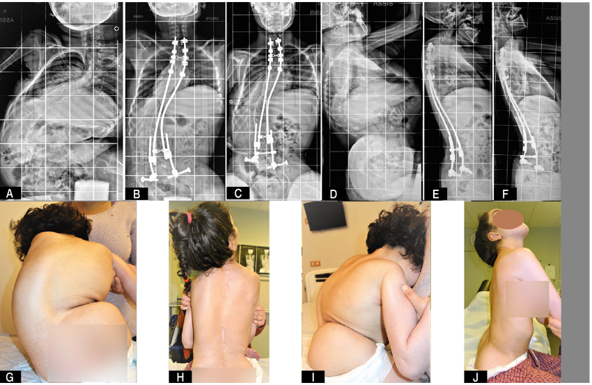 sequencia de imagens de radiografias e fotos de paciente com cirurgia de correção de escoliose neuromuscular