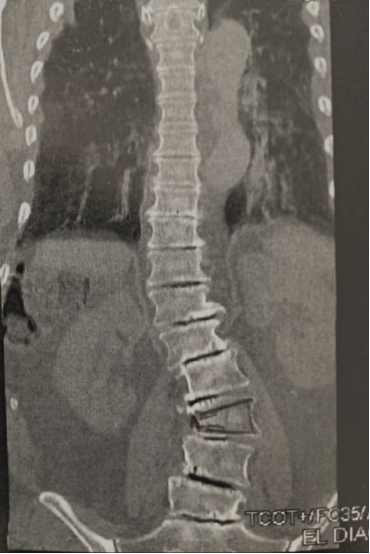 imagem de tomografia de coluna com escoliose degenerativa