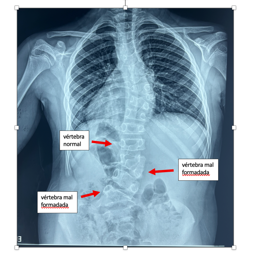 radiografia de coluna com escoliose e mal formação vertebral