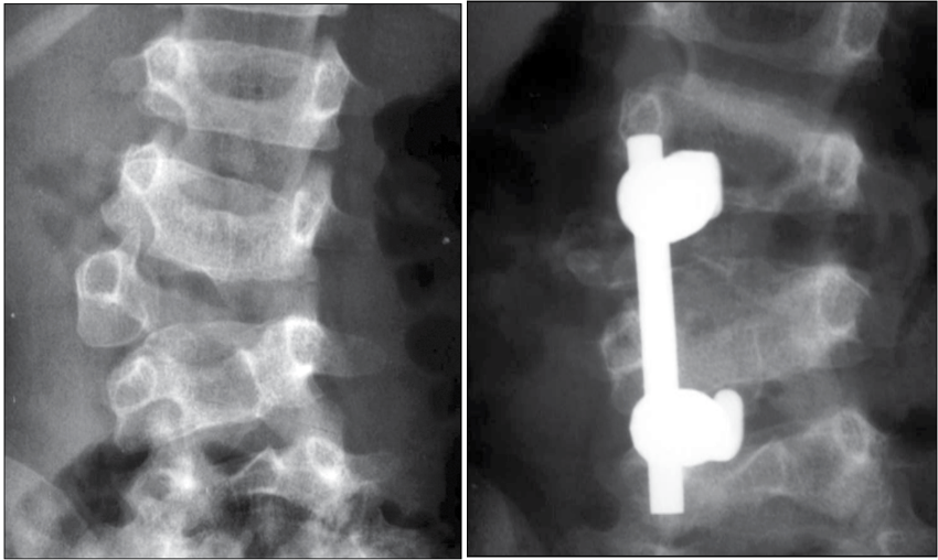 radiografias comparativas com antes e depois de cirurgia de escoliose congênita