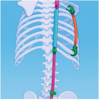 desenho mostrando anatomia da coluna e costelas com dispositivo VEPTR
