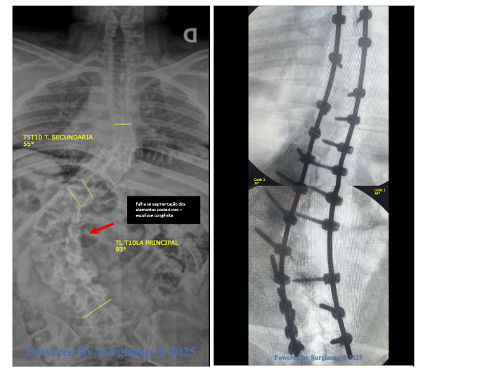 RADIOGRAFIA DE COLUNA ANTES E DEPOIS COM CORREÇAO CIRURGICA DE ESCOLIOSE CONGENITA