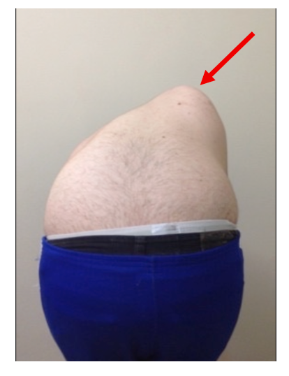 foto de homem sem camisa visto por tras com giba costal escoliose