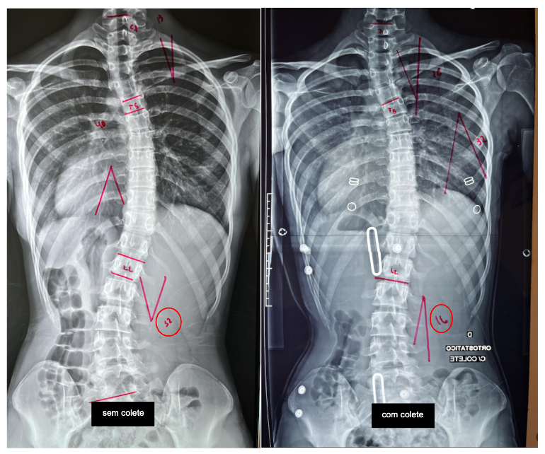radiografias comparando antes e depois do colete na escoliose