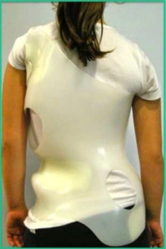 menina com escoliose usando colete para tratamento correção