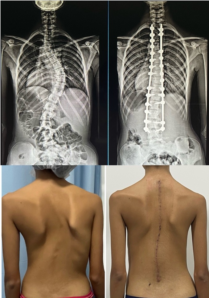 4 imagens com radiografias e paciente com antes e depois de cirurgia de escoliose