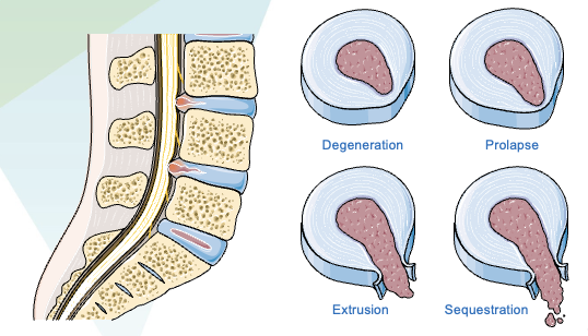hernia de disco lombar 