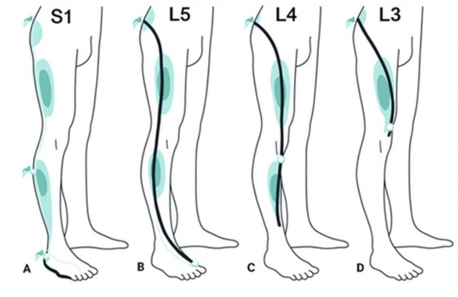 Imagem de pernas com trajeto da dor ciática