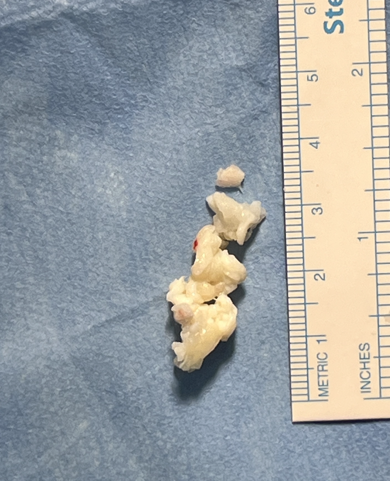 fragmento de disco intervertebral